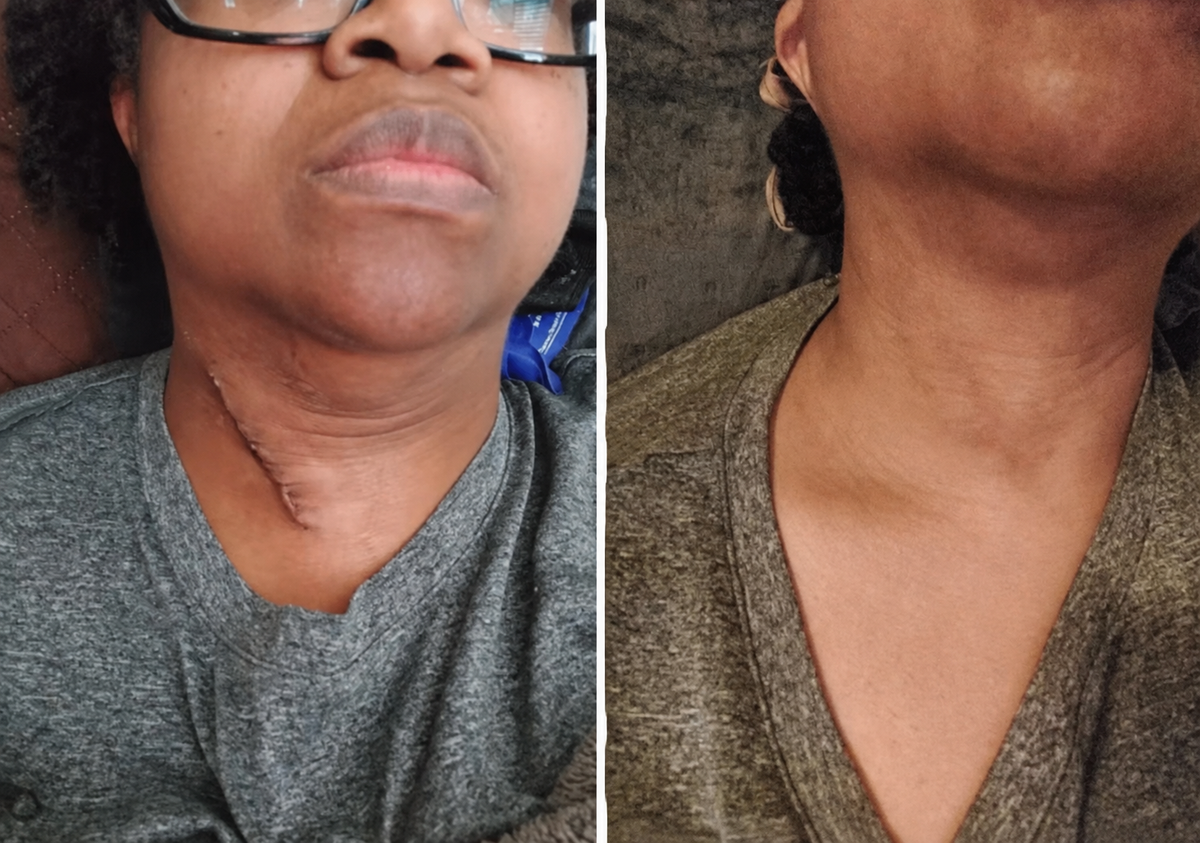 Clarion Clear Ray - For Stretch Marks, Acne & Scars