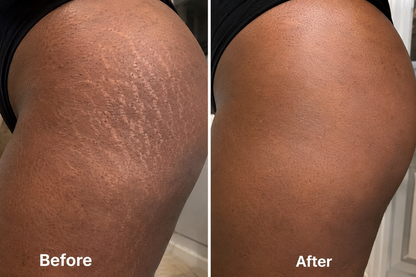 Clarion ClearRay — For Acne, Stretch Marks & Scar Repair
