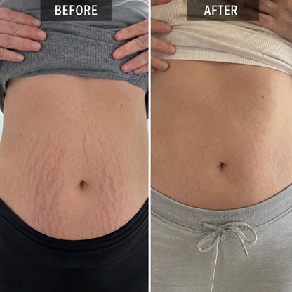Clarion Clear Ray - For Stretch Marks, Acne & Scars