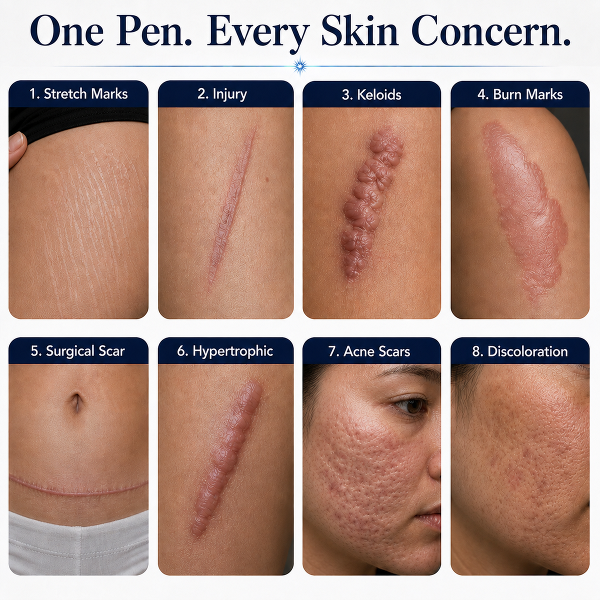 Clarion ClearRay — For Acne, Stretch Marks & Scar Repair