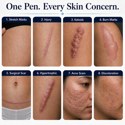 Clarion ClearRay — For Acne, Stretch Marks & Scar Repair