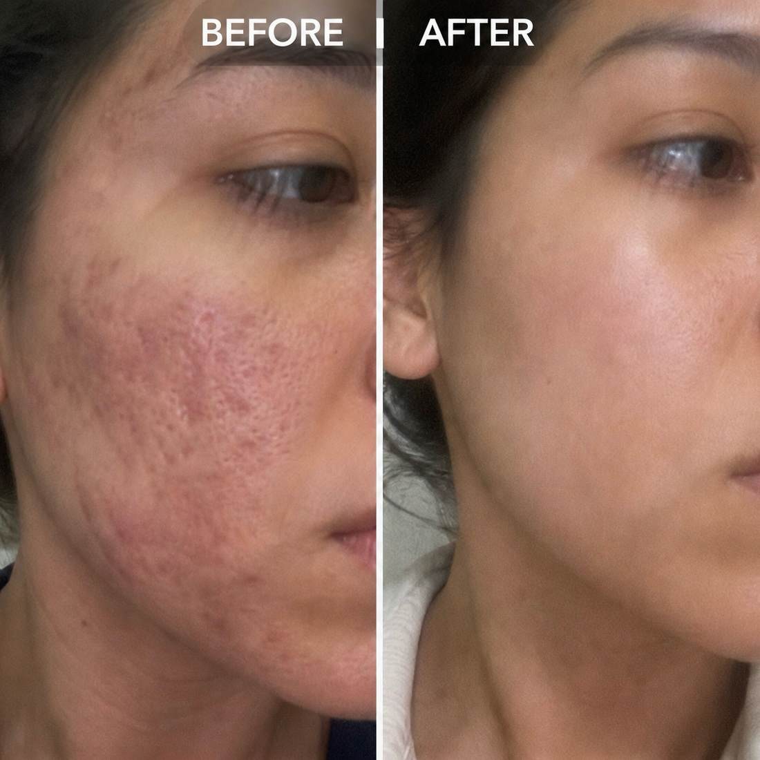 Clarion Clear Ray - For Stretch Marks, Acne & Scars