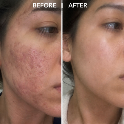 Clarion Clear Ray - For Stretch Marks, Acne & Scars