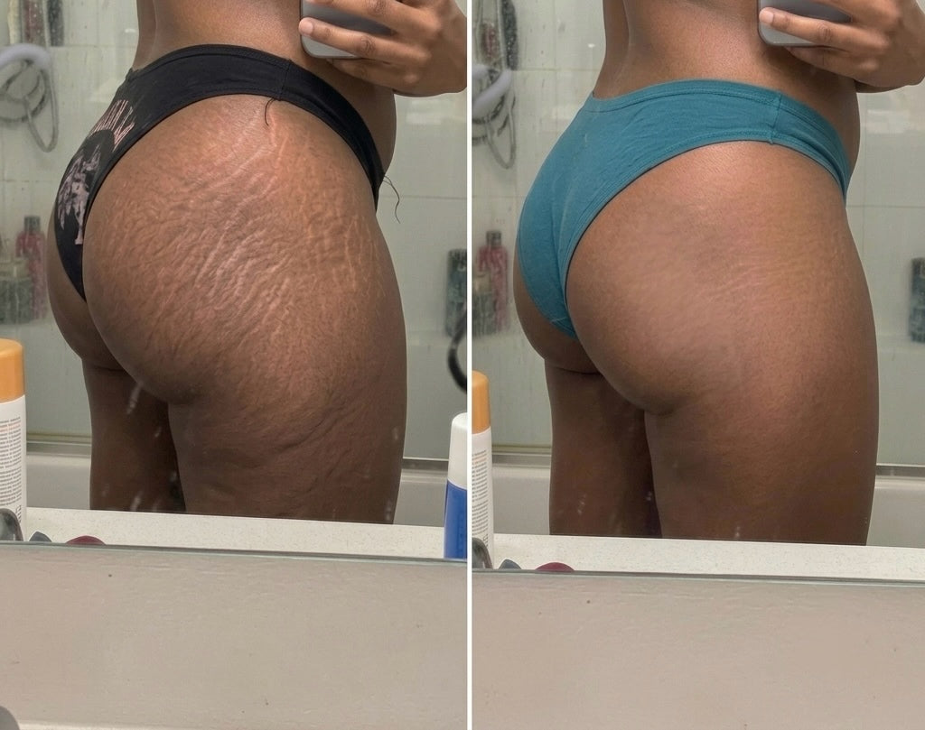Clarion ClearRay — For Acne, Stretch Marks & Scar Repair